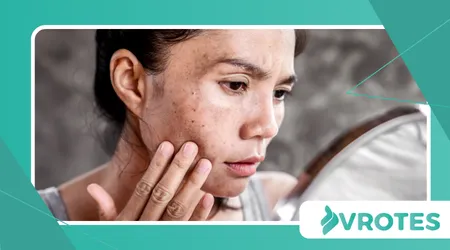 Menopause and Skin Hyperpigmentation